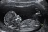 Pregnancy-scan