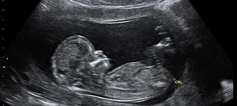 Pregnancy-scan