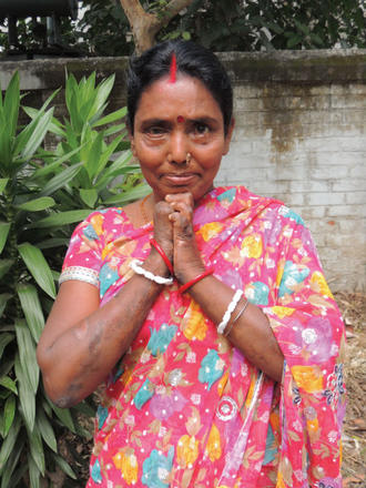 Manju Roy affected by leprosy